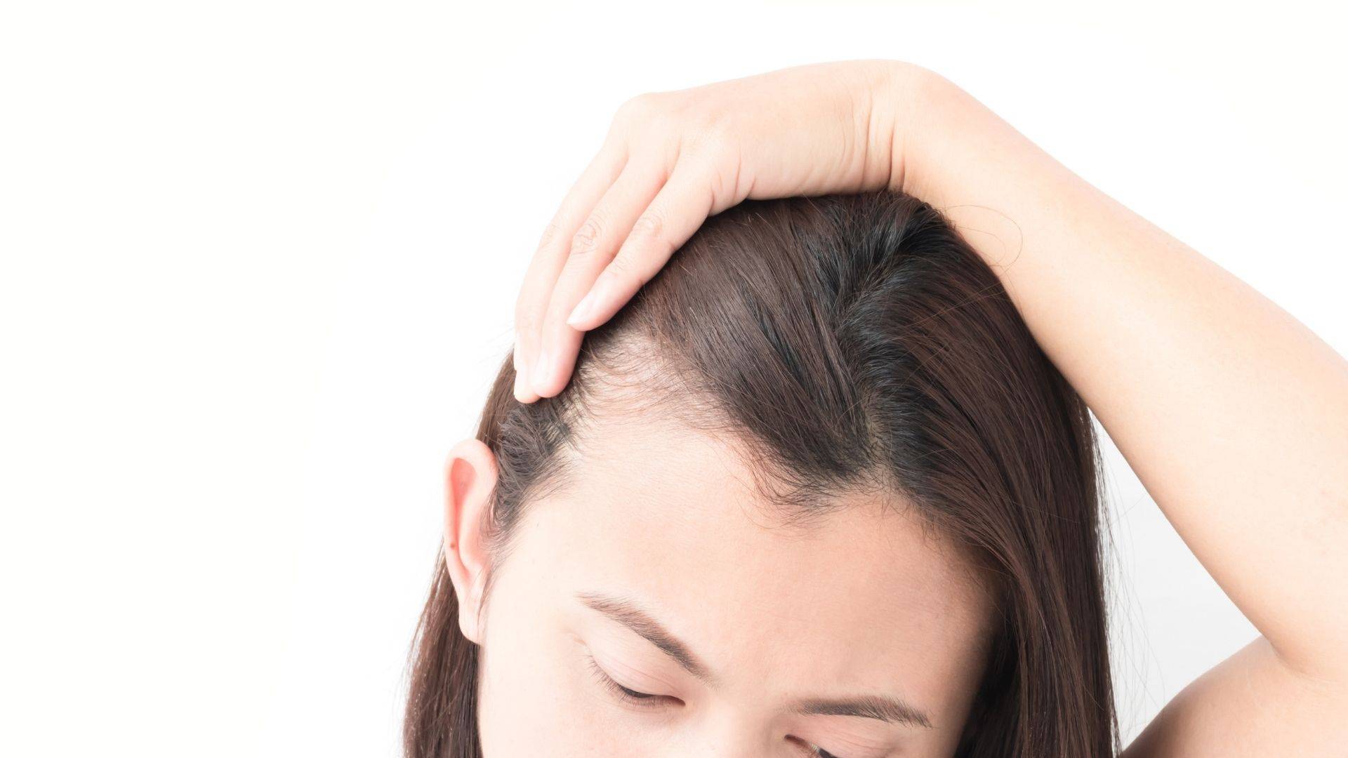 Woman showing hairloss