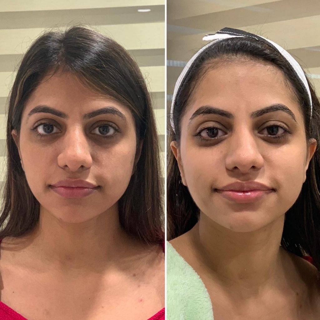 Woman before and after Oxygeneo Treatment
