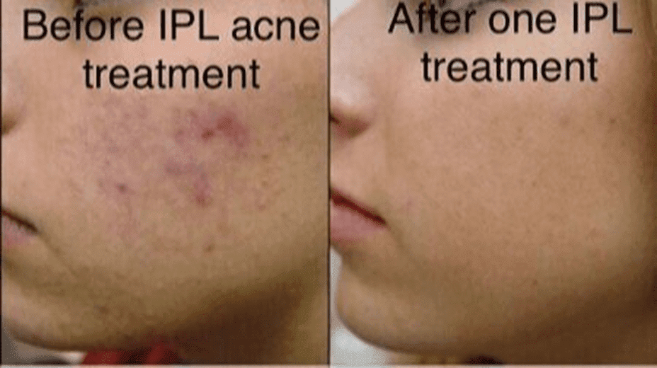 Acne before an after IPL photofacial