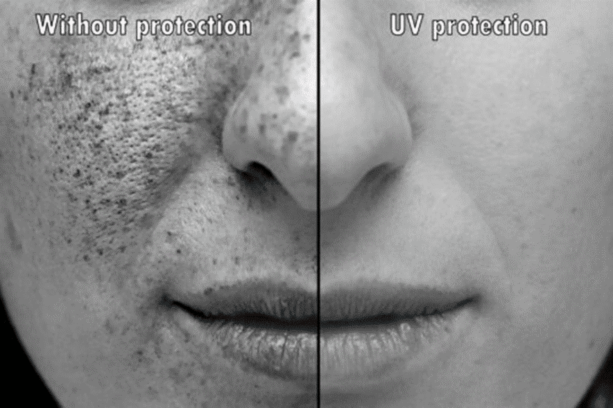 Facial Laser Treatment for Sun damaged skin