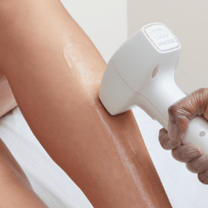laser hair reduction