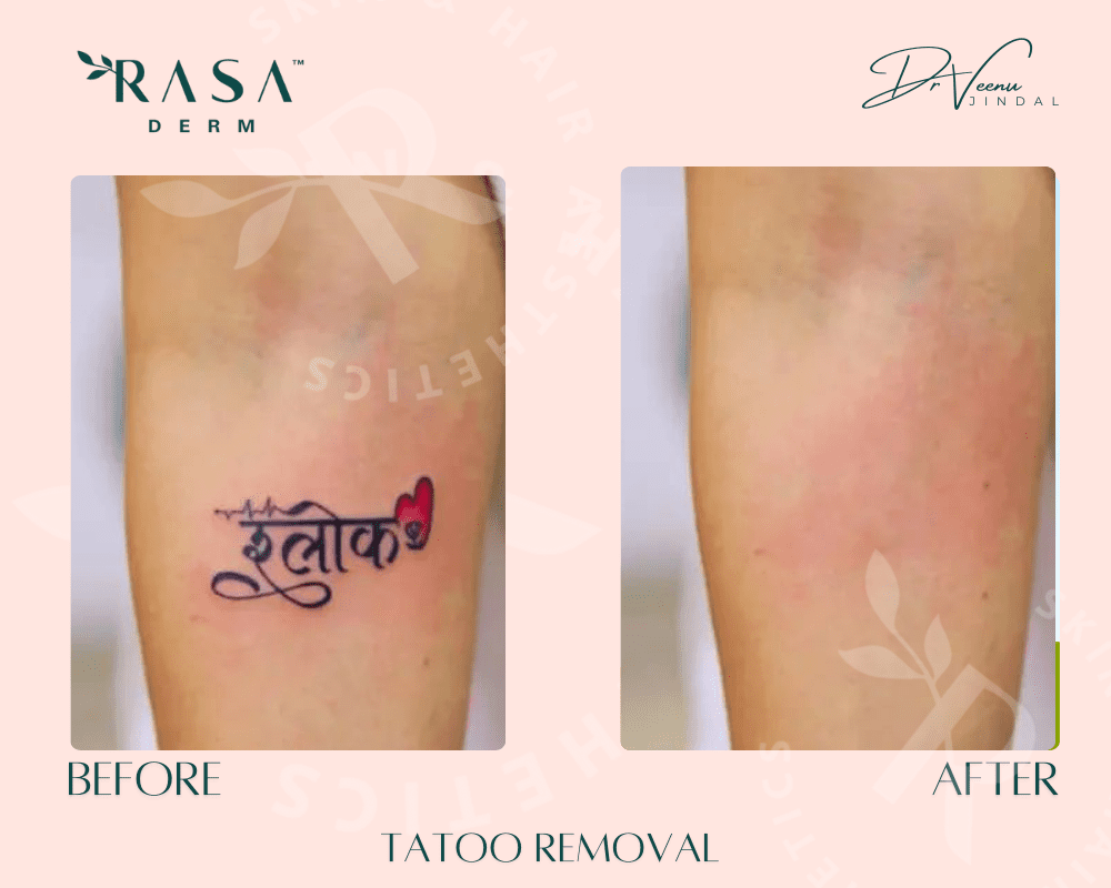 TATOO REMOVAL