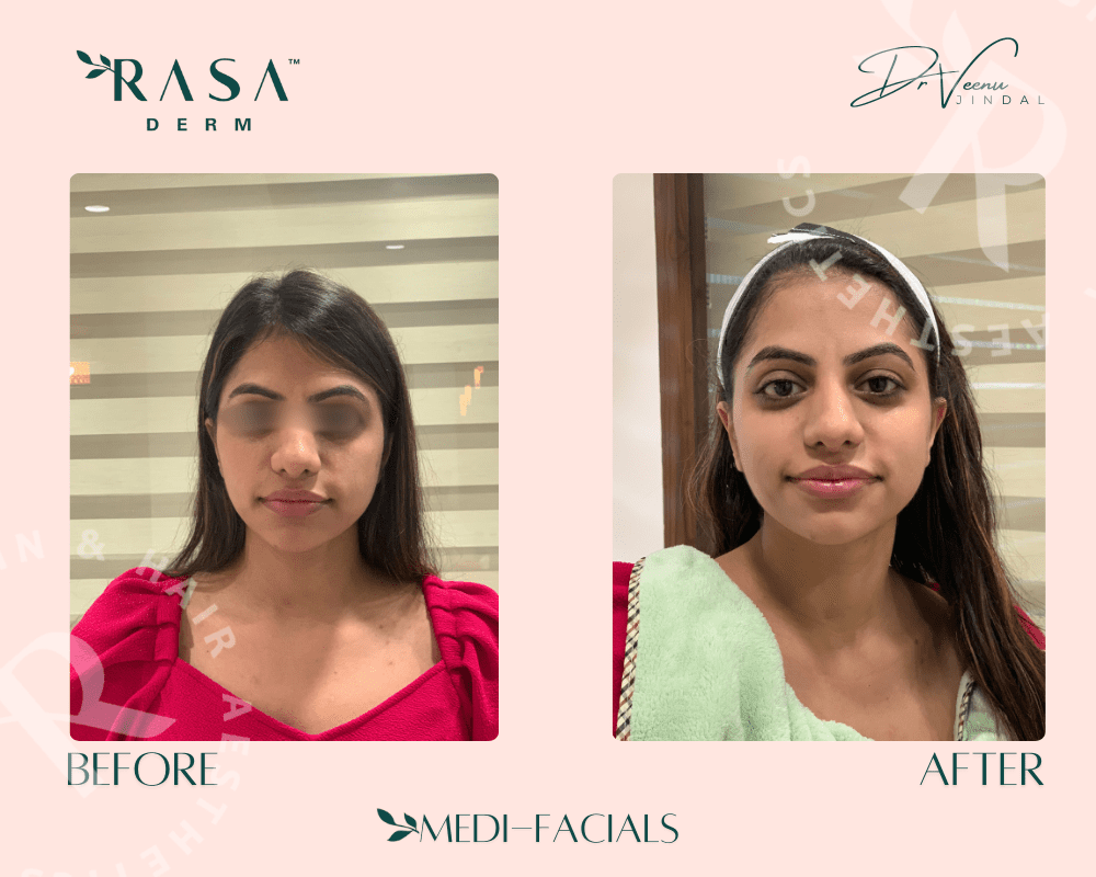 Best CO2 Laser Treatment in Delhi at RasaDerm