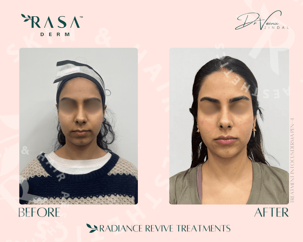 Rasa Derm's Microneedling Treatment in Delhi