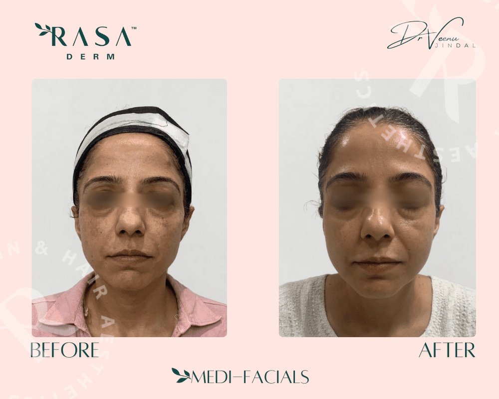 before and after Pigmentation treatment